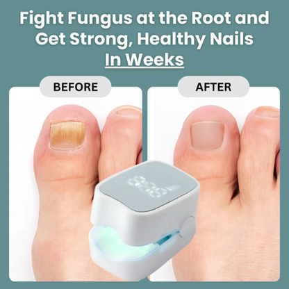 Urbanhut™ - Nail Fungus Laser Device