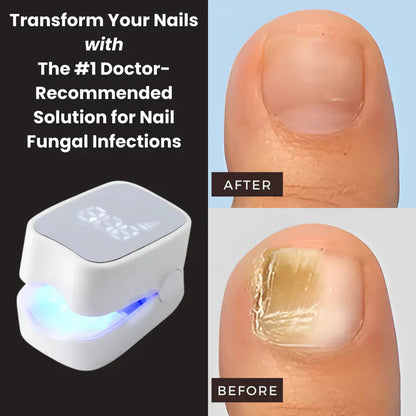 Urbanhut™ - Nail Fungus Laser Device